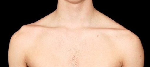 Acromioclavicular joint dislocation edited